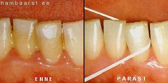Hambavahe enne ja pärast hambaniidi kasutamist