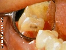 Kaariesest kahjustatud hammas