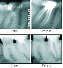 Juurekanalid enne ja pärast ravi