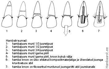 Hammaste traumade liigid