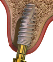 periimplantiit