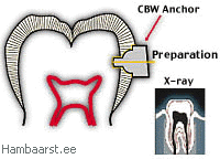The Crownless Dental Bridge - Anchor Implant System.