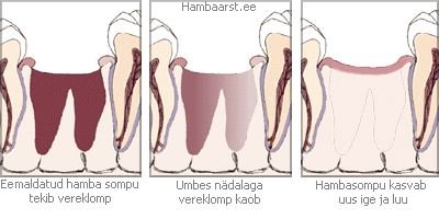 Eemaldatud hamba somp