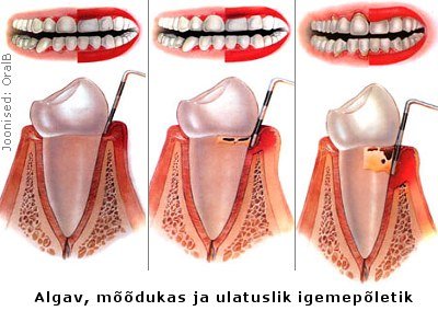 gingiviit