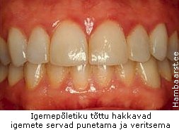 gingiviit