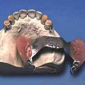 Замковые крепления в ортопедической стоматологии