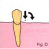 Замковые крепления в ортопедической стоматологии