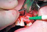 Одномоментная имплантация в сочетании с процедурой синуслифтинга и применением костных материалов 