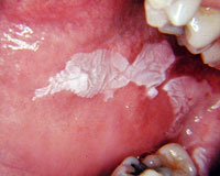 Роль табака в возникновении рака, заболеваний пародонта и поражений полости рта 