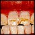 Fluoroosi ja tetratsükliinikahjustustega hammaste valgendamine