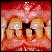 Äärmiselt kulunud hammaskondade proteetiline taastamine - 2.osa