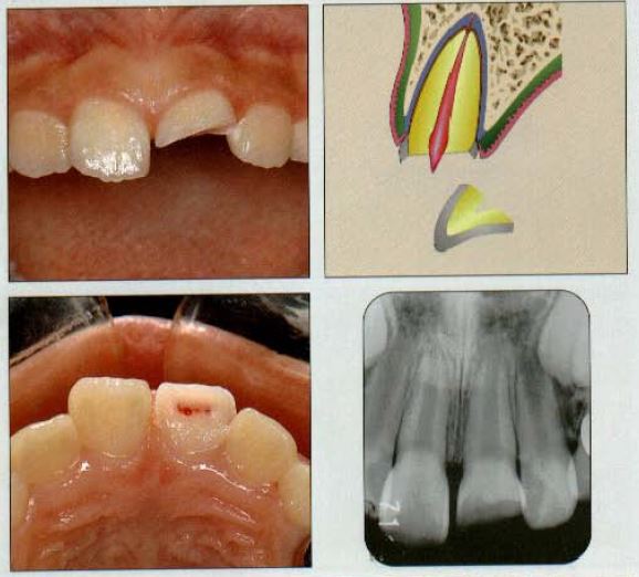 krooni murd paljastunud pulbiga (Mitsuhiro Tsukiboshi,DDS)