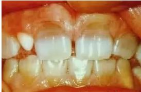 Tetratsükliini liigtarbimise tõttu värvunud hambad