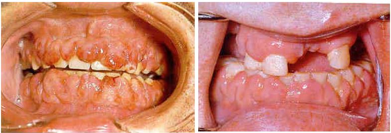 leukeemia