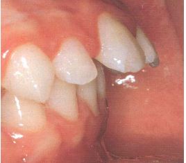 prognaatne hambumus, ülemised eeshambad on ettepoole alumiste suhtes ja eest