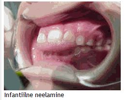 Infantiilne neelamine