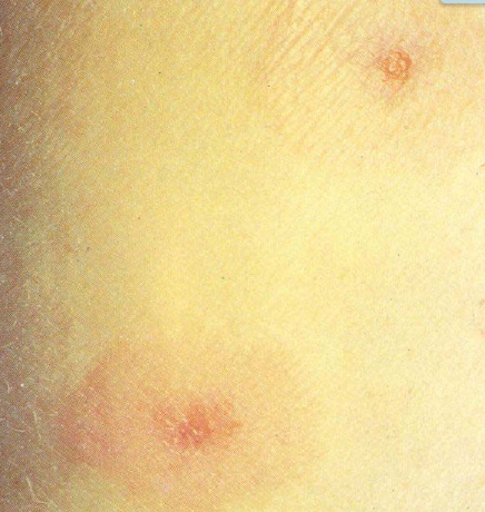 Erythema multiforme