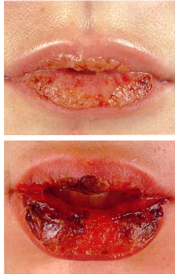 Erythema multiforme