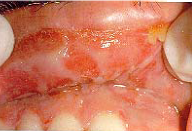 Erythema multiforme