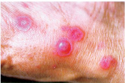 Erythema multiforme