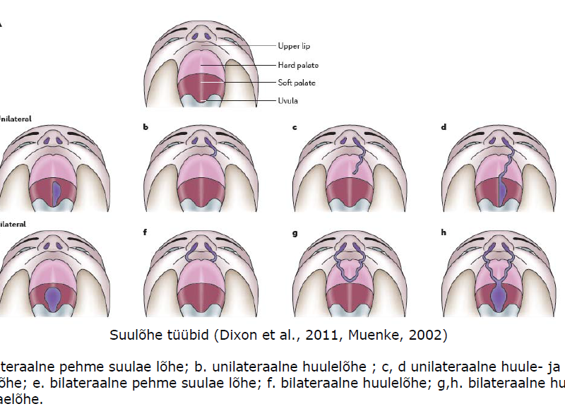 Suulõhe tüübid (Dixon et al., 2011, Muenke, 2002)