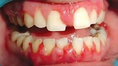 ANUG (äge nekrotiseeruv haavandiline gingiviit/parodontiit)