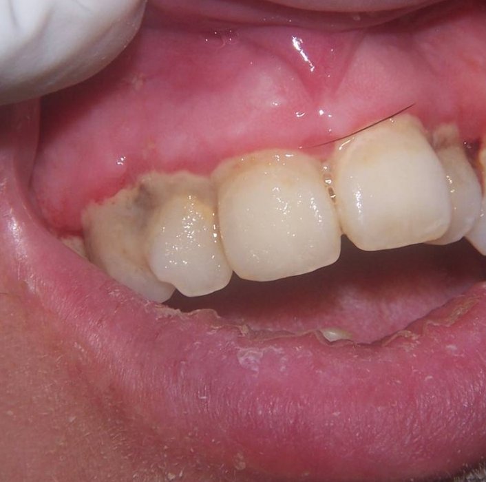 ANUG (äge nekrotiseeruv haavandiline gingiviit/parodontiit)