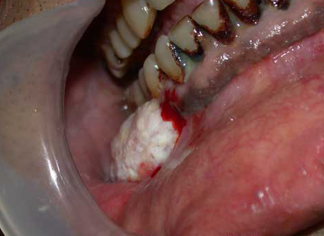 Mandibular neoplasms