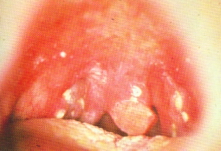 Infektsioosne mononukleoos (suudlemisnakkus), Epstein-Barri viirus (EBV)