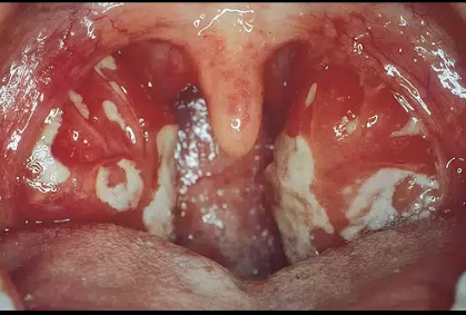 Mononucleosis,