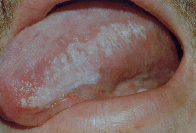 Karvane leukoplaakia