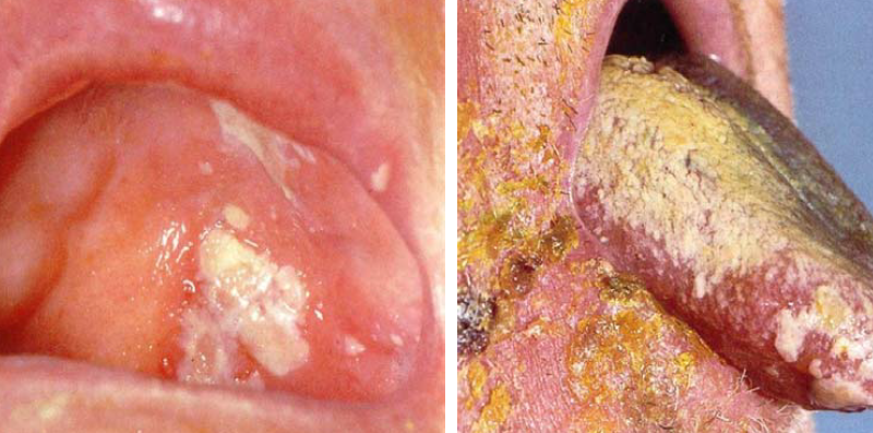 Herpes zoster - vöötohatis