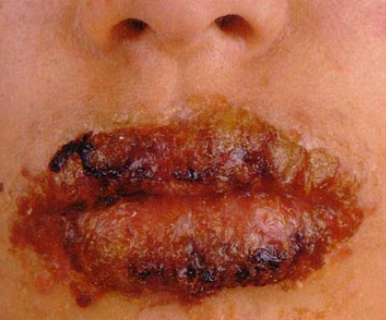 Herpes simplex