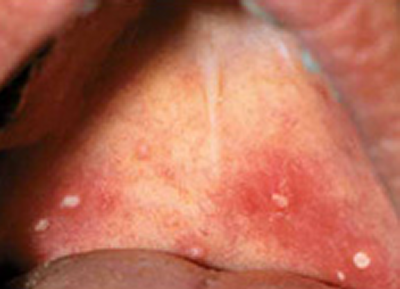 Coxackie-viirus infektsioon (nt Herpangiin, Vesikulaarne stomatiit)