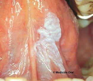 Leukoplaakia