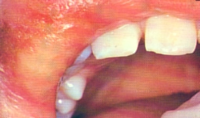 Termilised kahjustused lapse suulimaskestal