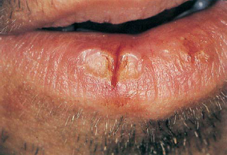 huule lõhe põhjustajaks Candida albicans