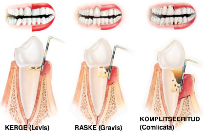 Gingiviit ehk igemepõletik