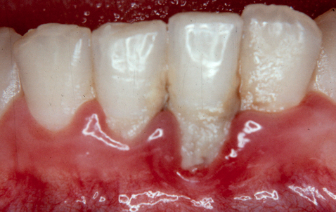 kaugele arenenud gingiviit