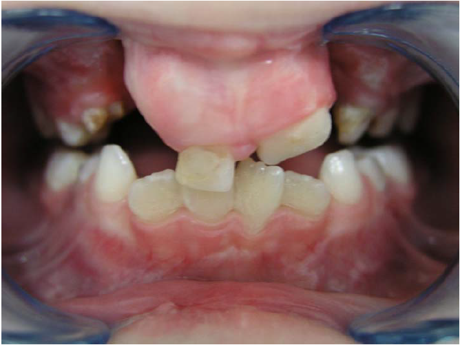 kahepoolse lõhega lapse hambumus
