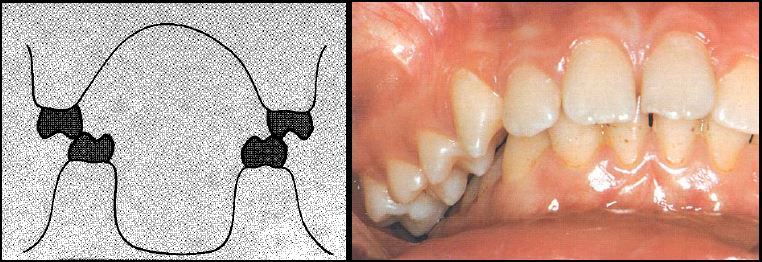 ülemine hambakaar on alumisest laiem nõnda palju, et hambad kokku ei puutu