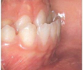 progeenne hambumus; alumised eeshambad on ettepoole ülemiste suhtes;