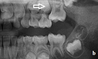 ) Röntgenülesvõte. Ülemise esimese jäävmolaari lõikumine on takistatud 2. piimamolaari tõttu
