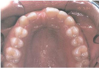 Kaasasündinud hammaste puudumine