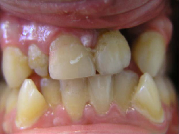 Ühepoolse lõhega lapse hambumus (puudub hammas lõhe piirkonnas).