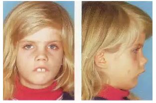 “Adenoidi nägu”. Kuueaastase lapse nägu kroonilise ninahingamise takistuse korral.