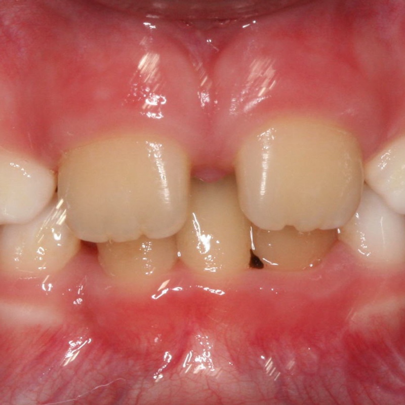 ruumipuudus eesmiste hammaste osas
