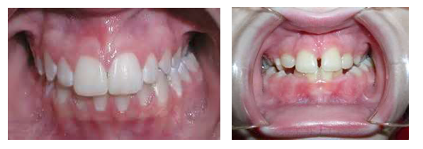 Ülemise hambakaare kitsenemine ehk tagumiste hammaste risthambumus.