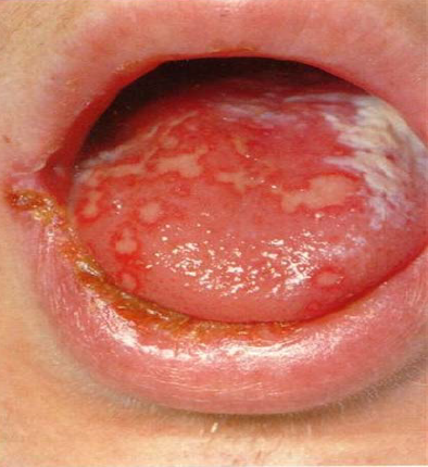 Herpes simplex