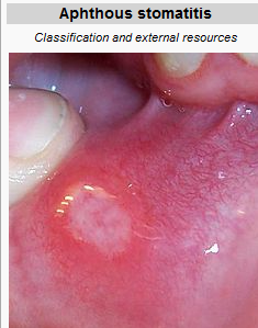 Stomatitis aphtosa